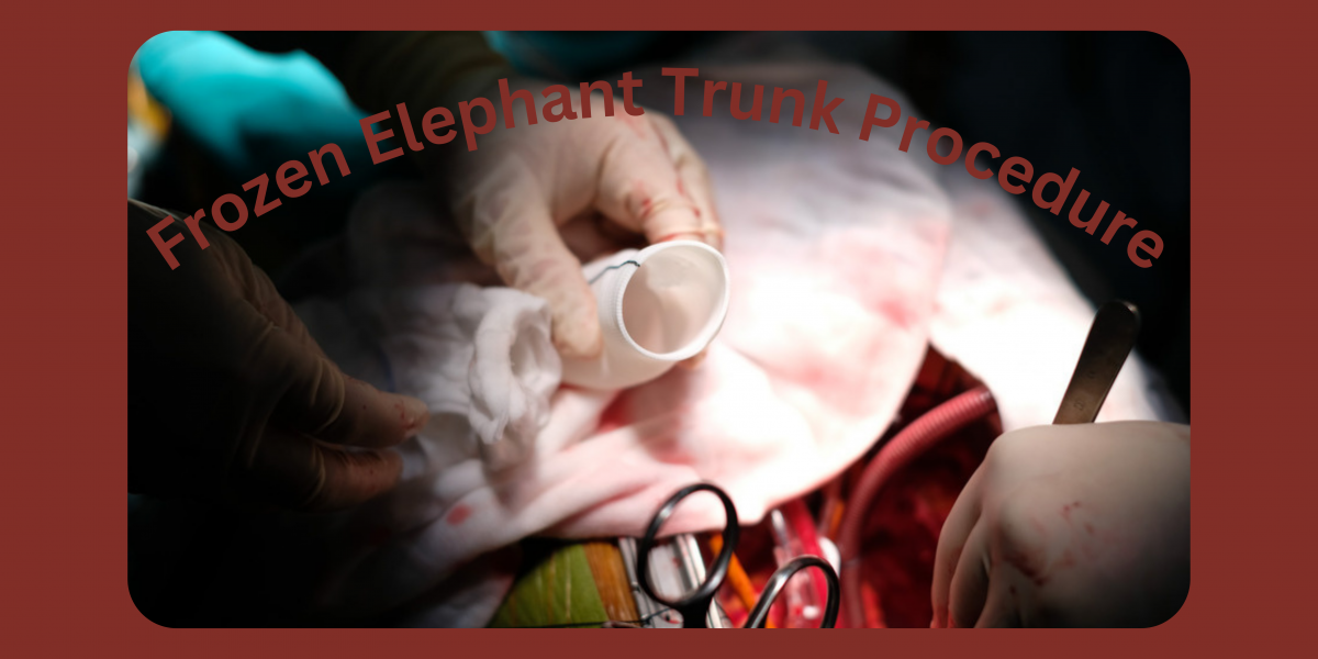 5 Useful Articles on the Frozen Elephant Trunk Procedure - CTSNet